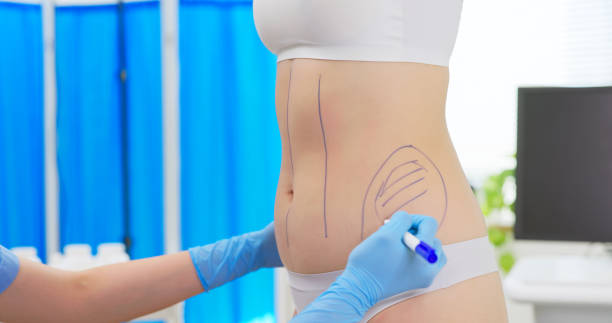 Is Liposuction Surgery Right for You?