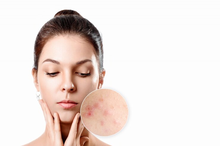 Is Natural Acne Treatment Better Than Medicated?