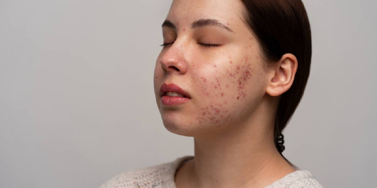 best skincare for acne
