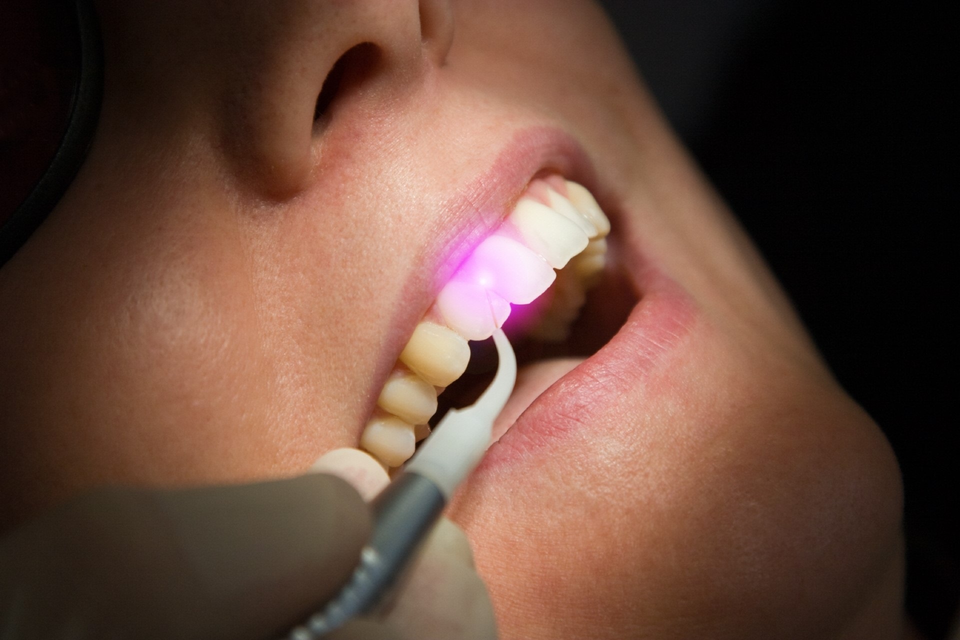 pinhole surgery in islamabad