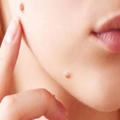 Warts Removal Treatment In Islamabad