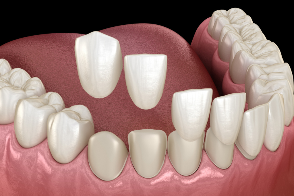 composite veneers in islamabad