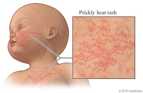 How to Differentiate Prickly Heat from Other Skin Rashes