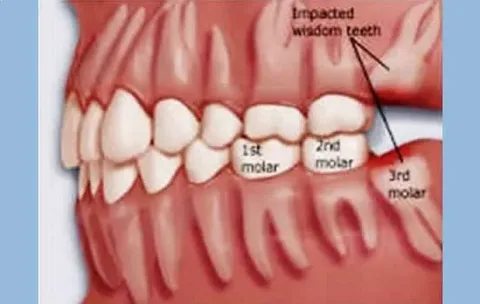 Wisdom Teeth Removal Newtown