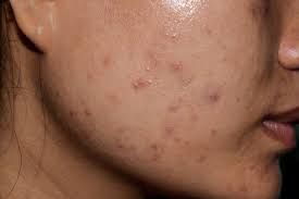 Acne Scar Treatment in Dubai