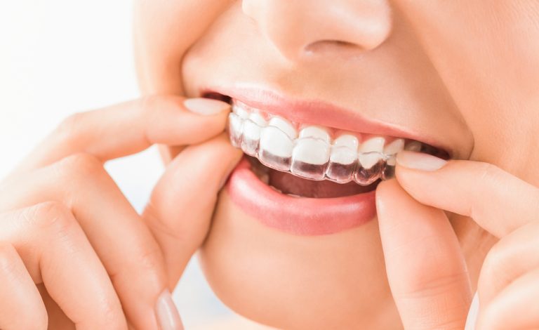 invisalign dubai