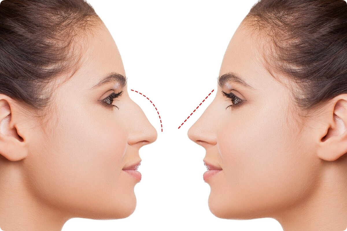 rhinoplasty