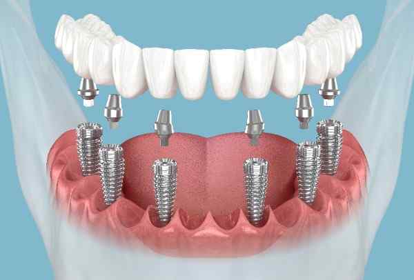 Smilo Dental Implants
