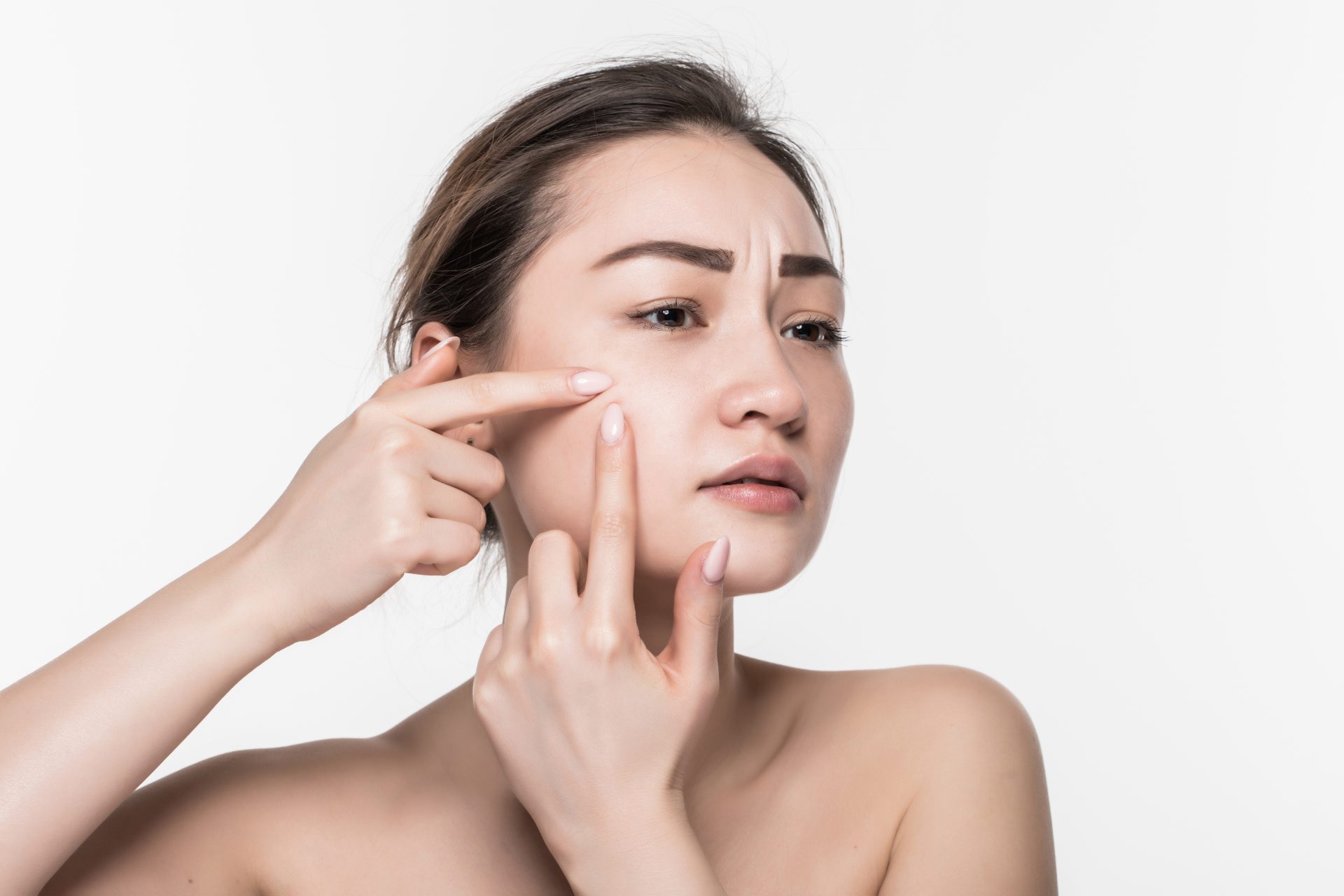 Acne Treatment In Dubai