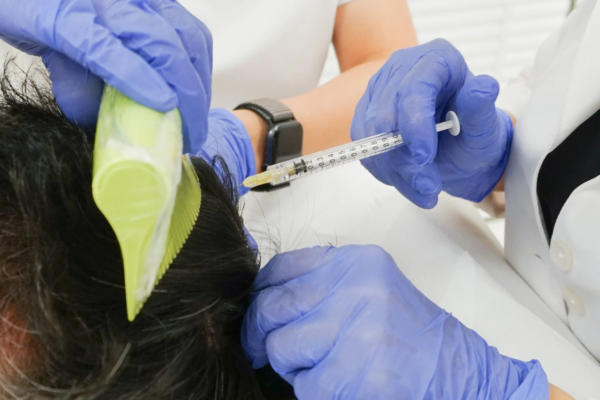 Best PRP Hair Treatment in Dubai
