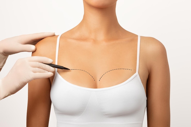 Breast Augmentation Surgery: Transform Your Looks with Natural Results