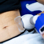 CoolSculpting for a Contoured Waist and Lean Silhouette
