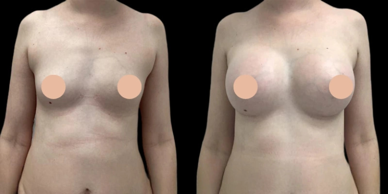 Best Breast Augmentation Surgeons in Dubai