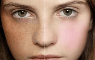 Melasma Treatment in Islamabad