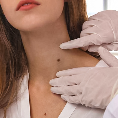 Mole Removal Islamabad