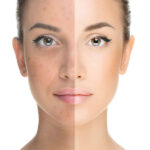 How to Pick an Acne Treatment That Suits Your Skin Type
