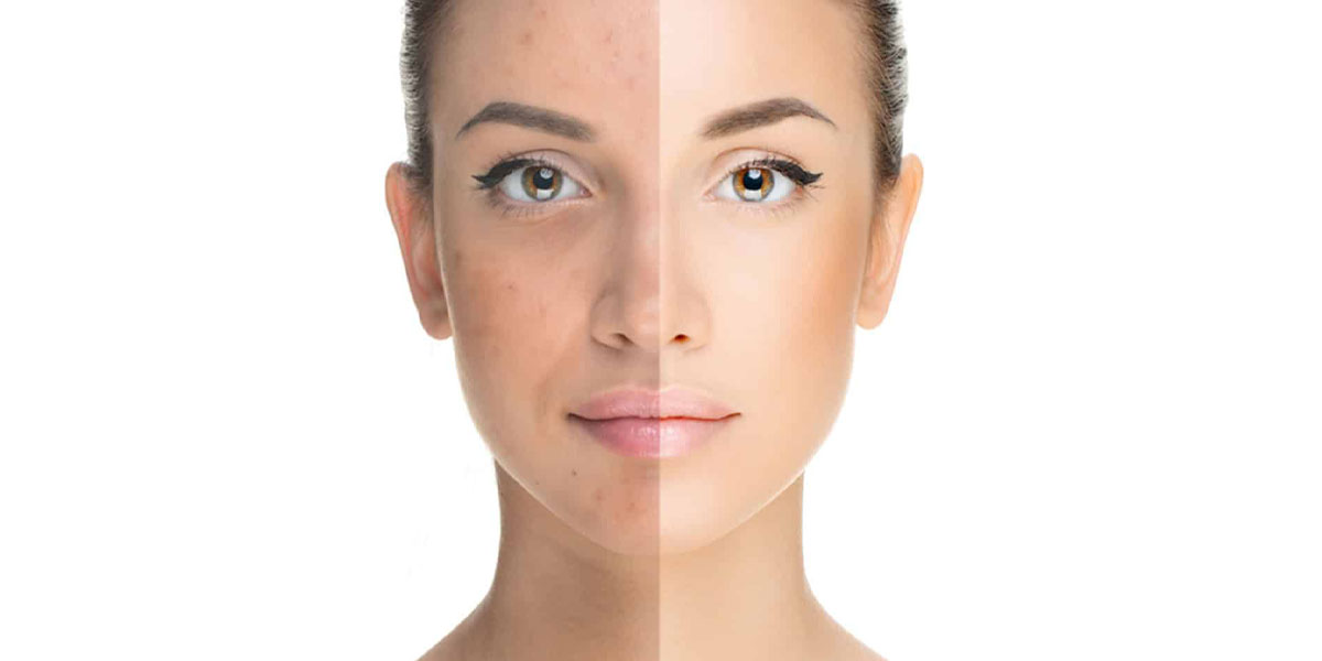 Acne Treatment In Dubai