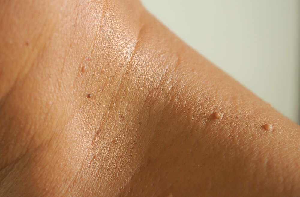 Skin Tag Removal in Dubai
