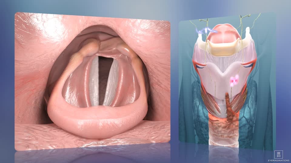 Voice Therapy for Vocal Cord Nodules: Does It Really Work?