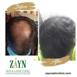 hair transplant in pune