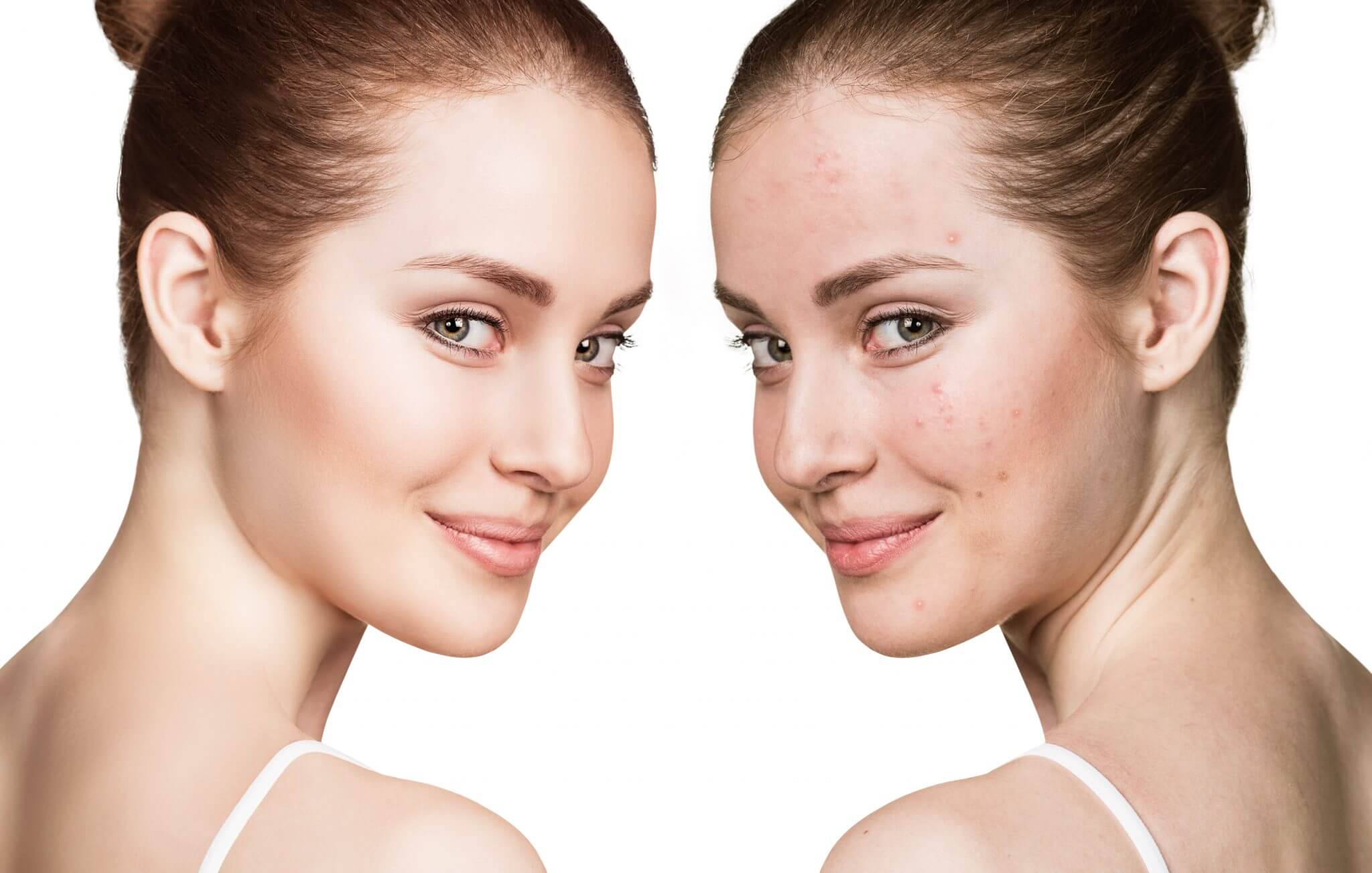 Cold Peel in Dubai