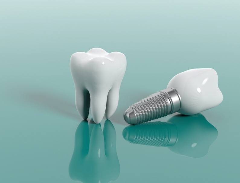 dental implant in islamabad Pakistan