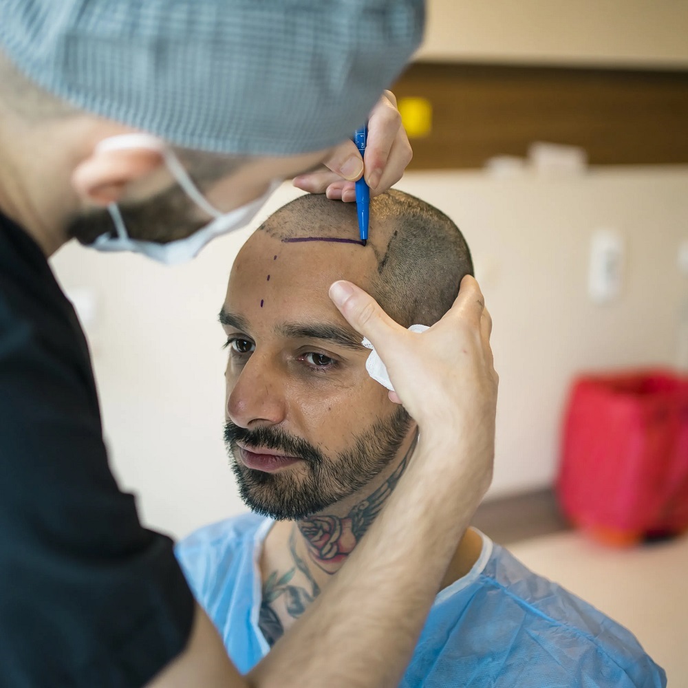 hair transplant in islamabad, pakistan