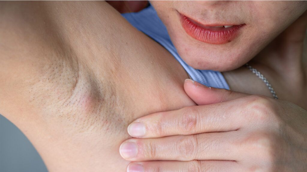 Underarm whitening treatment in Dubai