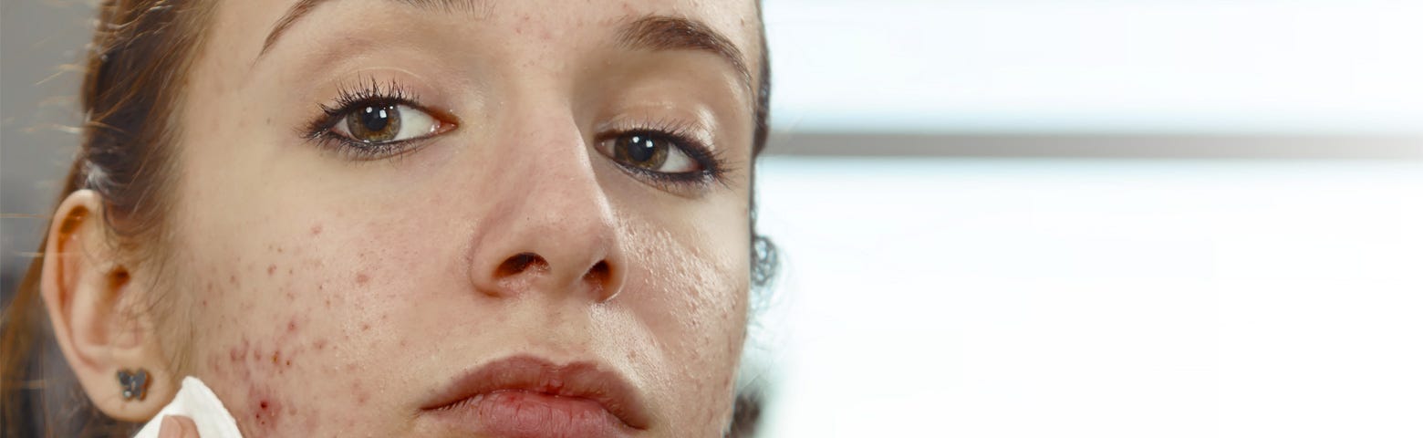 Can smoking weed cause hormonal acne? Explore how marijuana might affect your hormones, trigger breakouts, and become a hidden skin irritation cause.