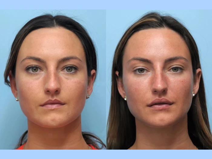 Best Aesthetic Clinics in Dubai for Thread Lift and Youthful Skin