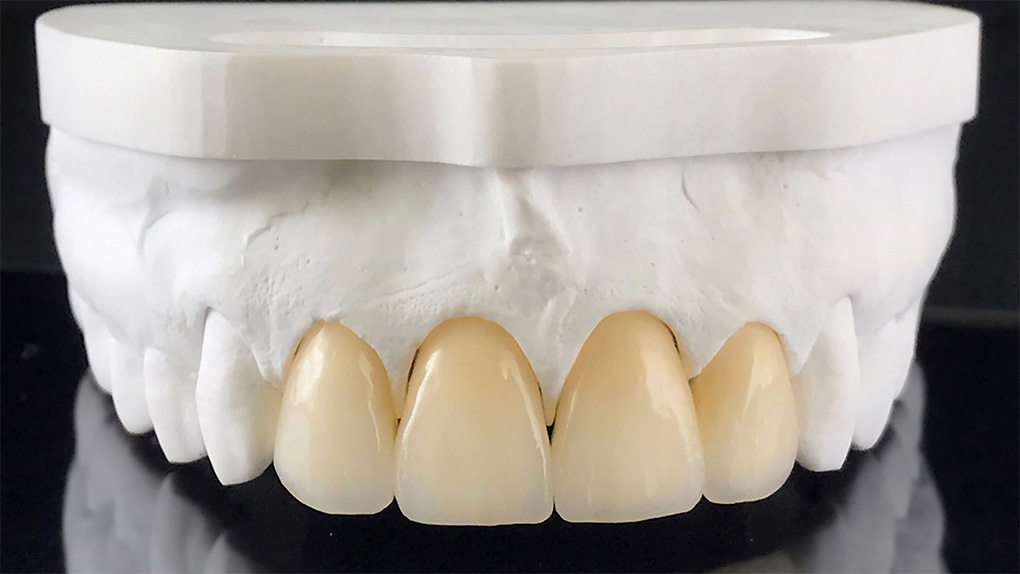 Zirconia Crown Dubai: The Durable & Aesthetic Choice for Tooth Restoration