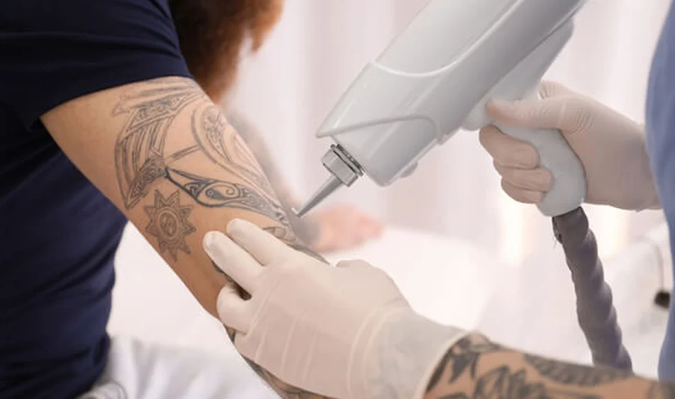 Pico Laser Tattoo Removal Dubai