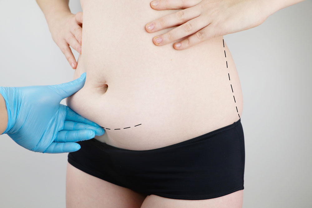 Fat Transfer in Dubai