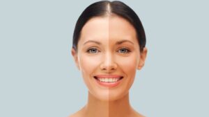 Permanent skin whitening injection price in Dubai
