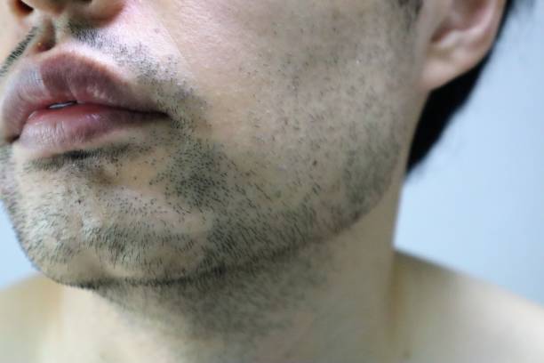 Do Beard Hair Transplants Look Natural