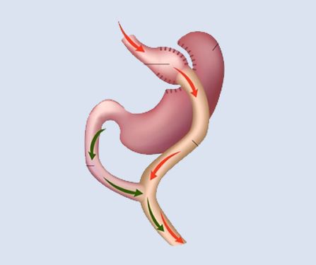 Gastric Balloon in Riyadh
