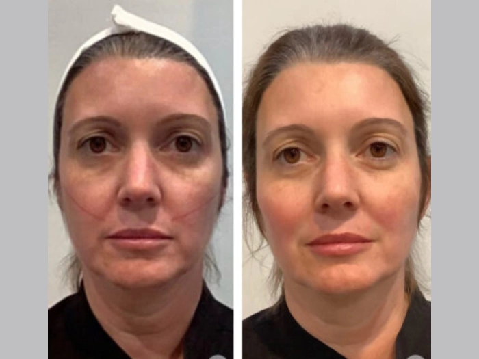 Thread Lift in Dubai: The Procedure, Costs, and Everything You Should Know