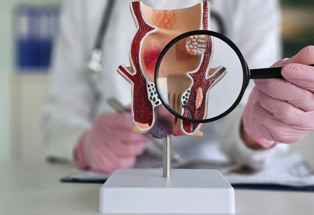 Trusted Hemorrhoid Specialists Riyadh