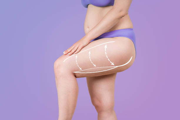 Is Buttock Lift Surgery an Outpatient Procedure?