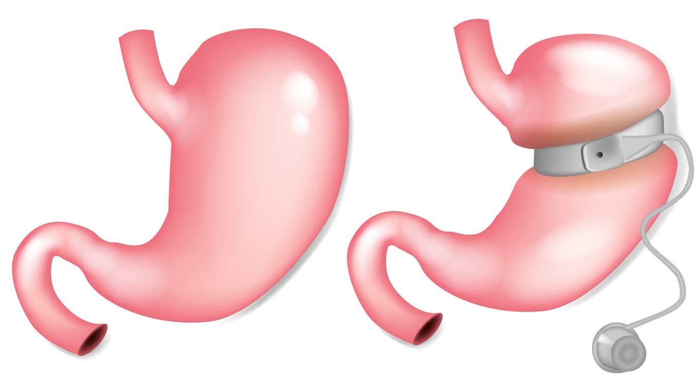 Gastric Balloon Placement in Dubai
