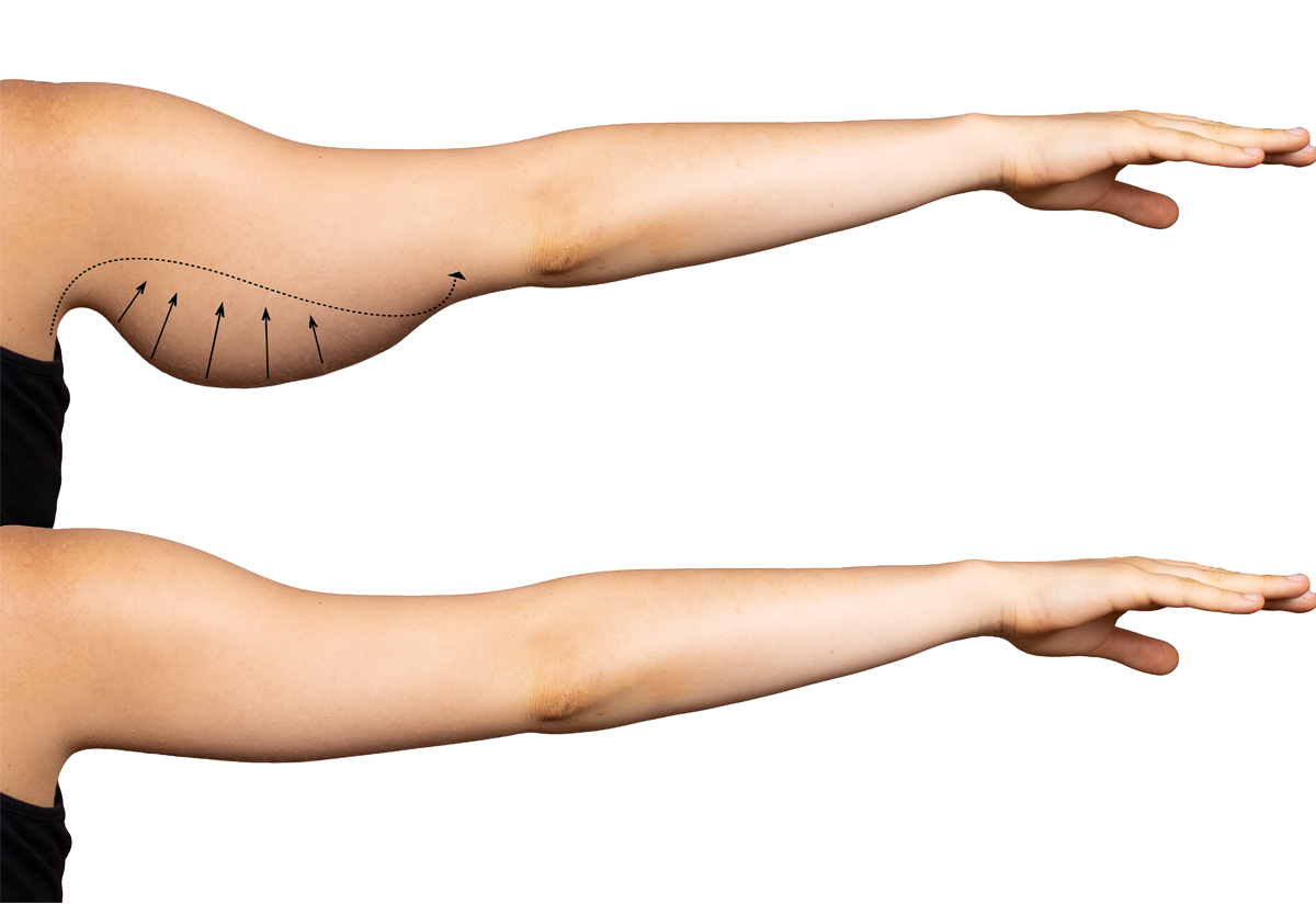 Surgical Arm Fat Reduction in Islamabad