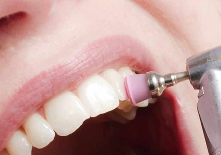 Teeth Cleaning for Sensitive Teeth Riyadh