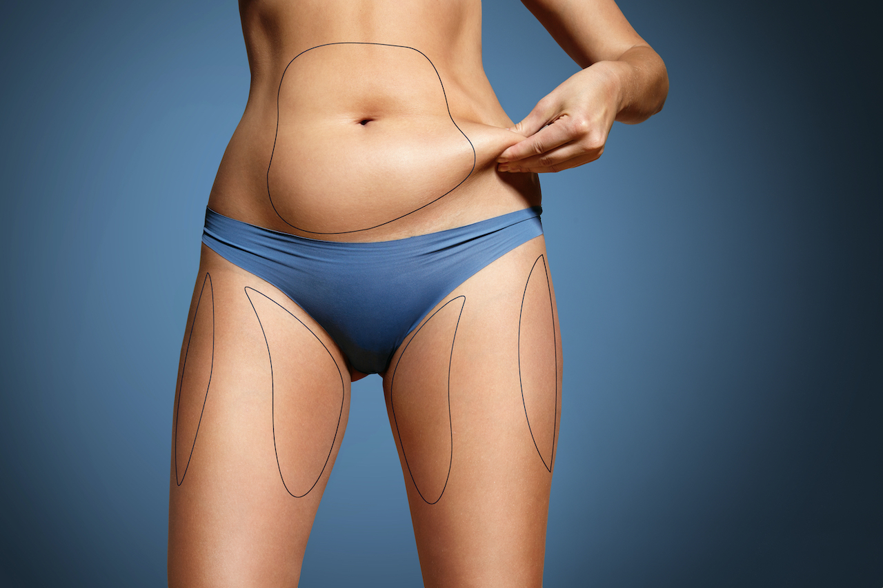 fat transfer in dubai
