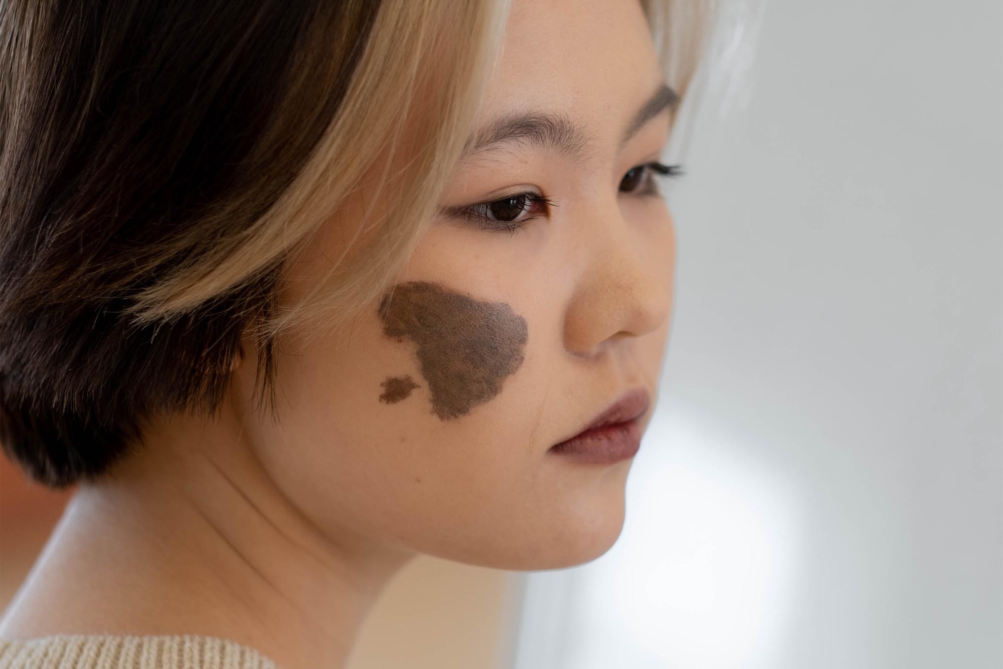 What’s the Cost of Birthmark Removal?