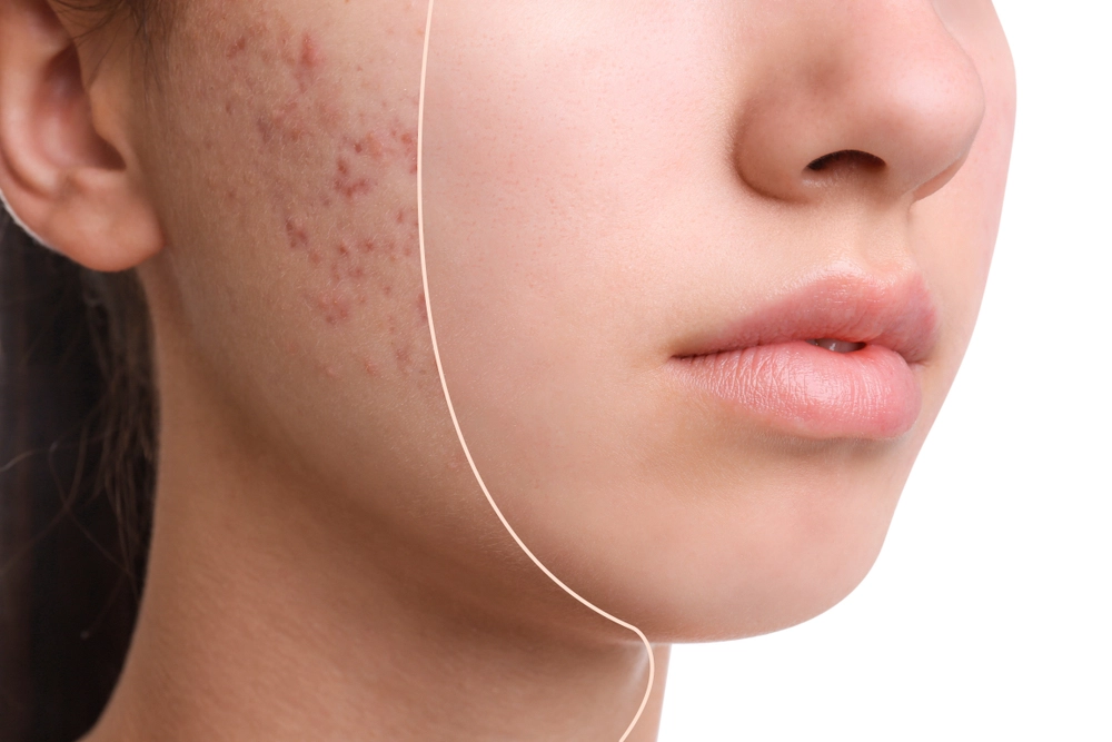 Acne Treatment In Dubai