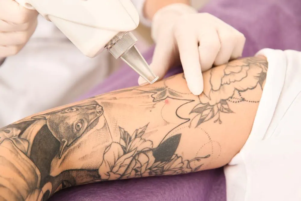 Laser Tattoo Removal in Dubai