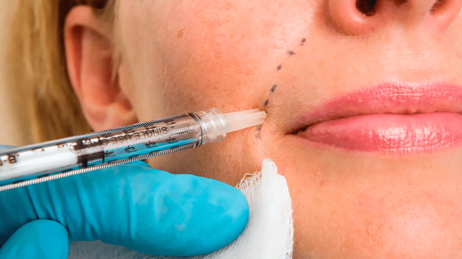 Juvederm Fillers in Dubai