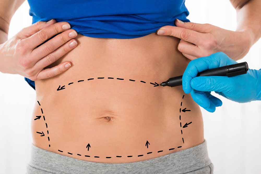 Liposuction in Dubai