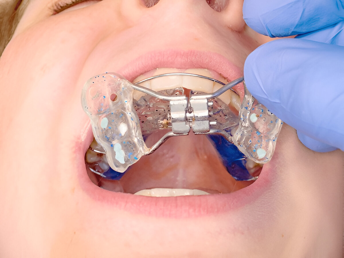 palate expander