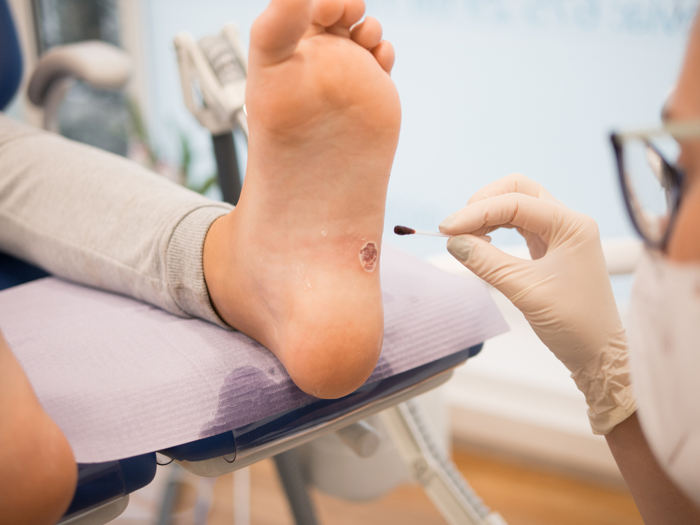 treatment of plantar warts